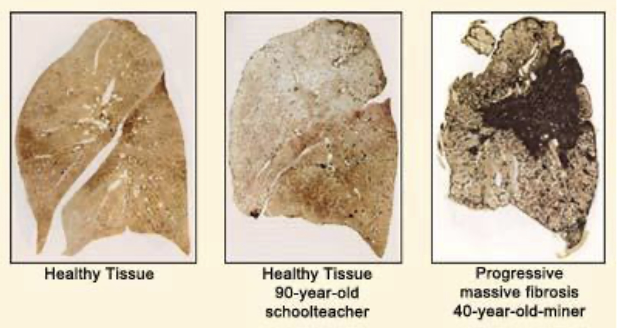 Black Lung Disease