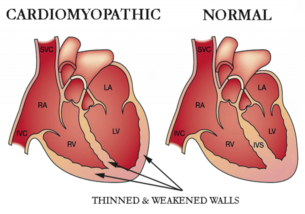 Cardiomyopathy