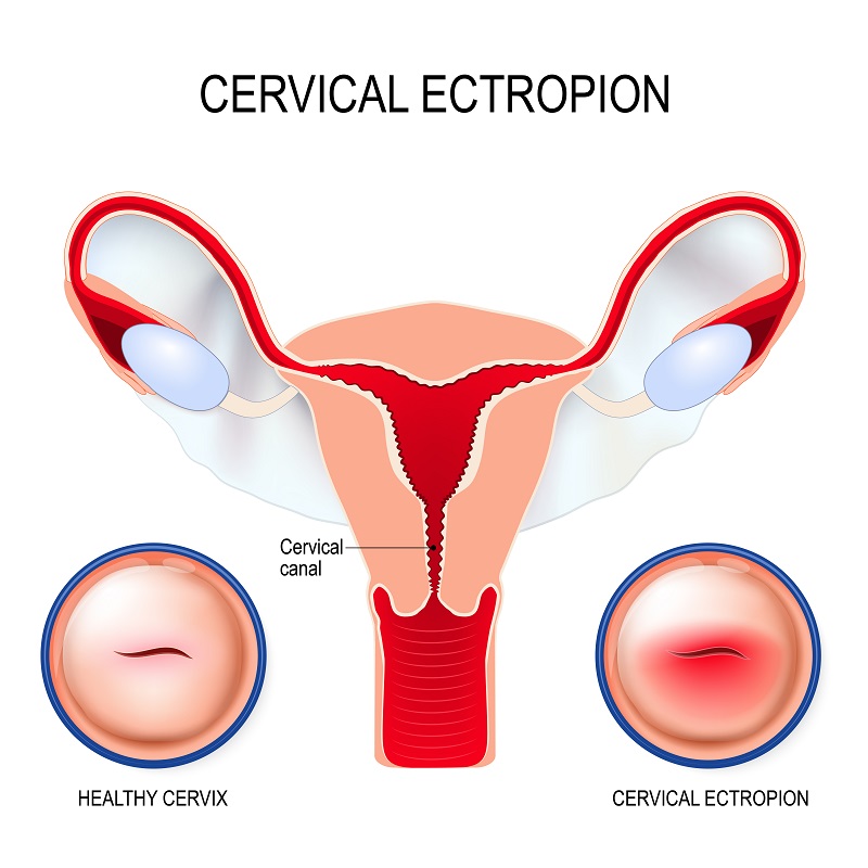 Cervical Ectropion