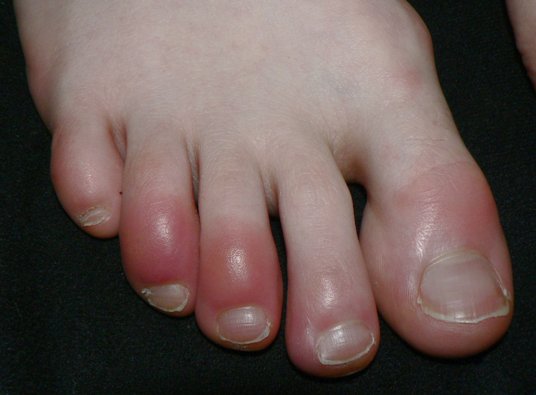 Chilblains