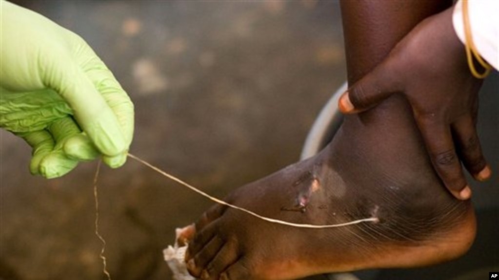 Guinea Worm Infection