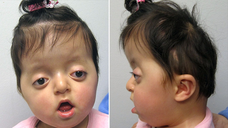 Pfeiffer Syndrome