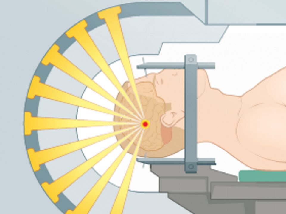Stereotactic radiosurgery
