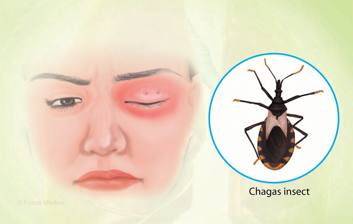chagas disease